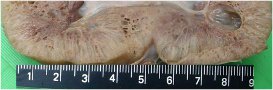 Rin de la nia: Corte de rin con dilataciones tubulares de corteza a mdula.
