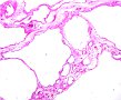 Corte histolgico de rin del nio: Dilatacin variable de tbulos.