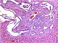 Una lesin heptica de la nia: Dilatacin de conductos en rea portal.